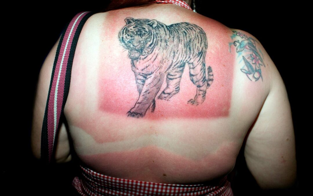 Solforbrændt kvinde, der har glemt at smører sig i solcreme og nu trænger til sun lotion.